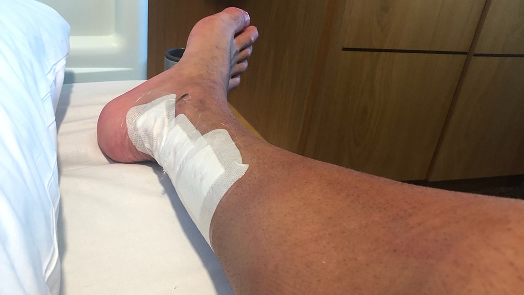bennellcalf1300719.jpg Harley Bennell had more surgery on his right calf. All pictures: Contributed - AFL,Harley Bennell,Injuries,Exclusive,Tag-Exclusive